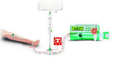 Dispositif Valve anti-reflux