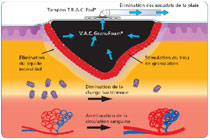 Mécanisme d'action VAC® Therapy