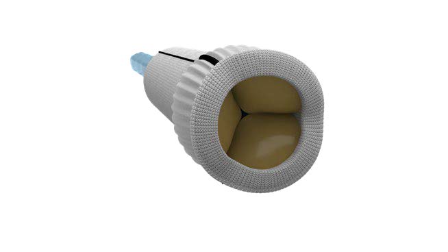 Le conduit aortique valvé KONECT RESILIA 