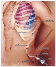 Aspira drainage pleural (poitrine)